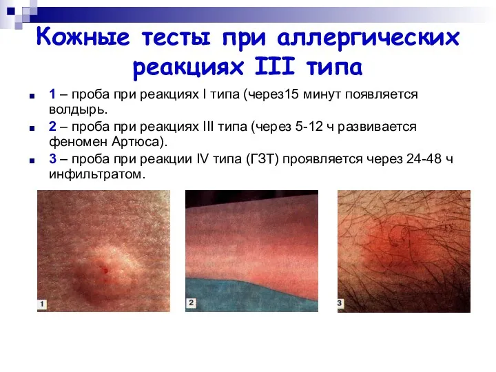 Кожные тесты при аллергических реакциях III типа 1 – проба при реакциях I