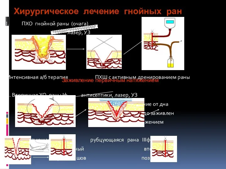 Хирургическое лечение гнойных ран ПХО гнойной раны (очага) лазер, УЗ Интенсивная а/б терапия