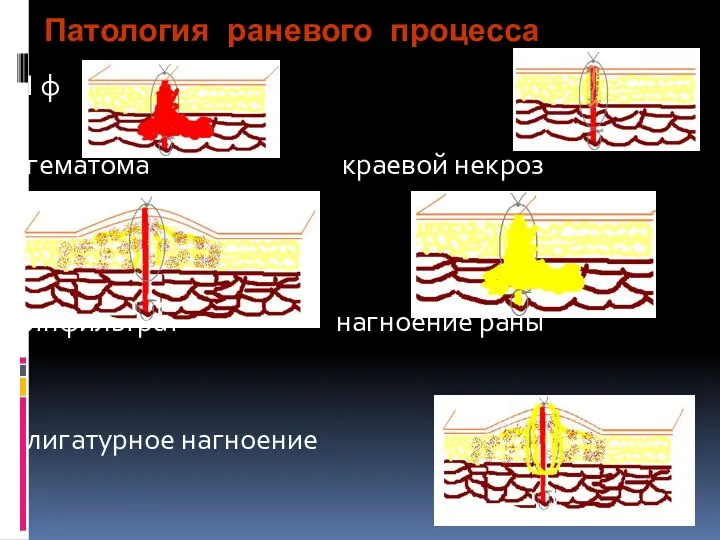 Патология раневого процесса I ф гематома краевой некроз инфильтрат нагноение раны лигатурное нагноение
