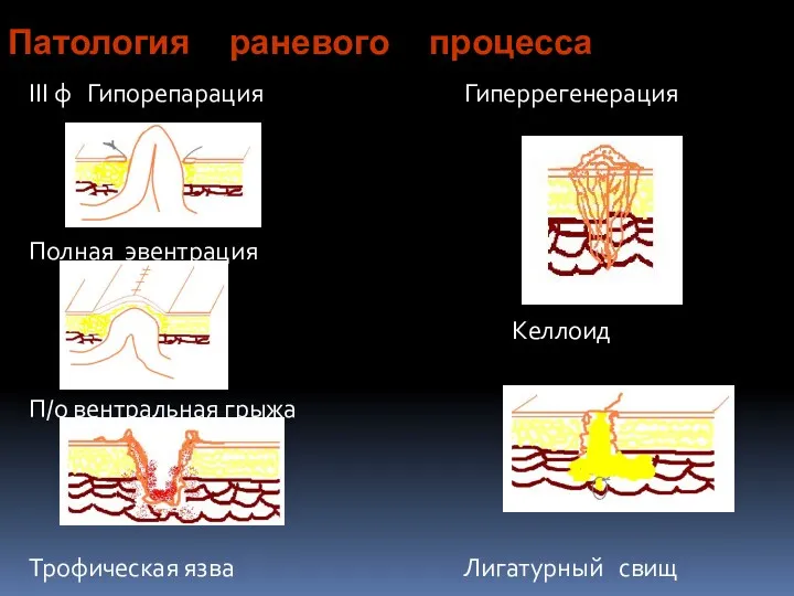 Патология раневого процесса III ф Гипорепарация Полная эвентрация П/о вентральная грыжа Трофическая язва