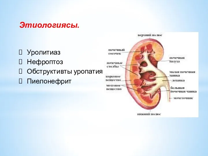 Этиологиясы. Уролитиаз Нефроптоз Обструктивты уропатия Пиелонефрит