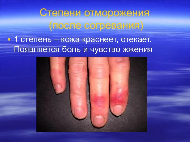Степени отморожения (после согревания) 1 степень – кожа краснеет, отекает. Появляется боль и чувство жжения