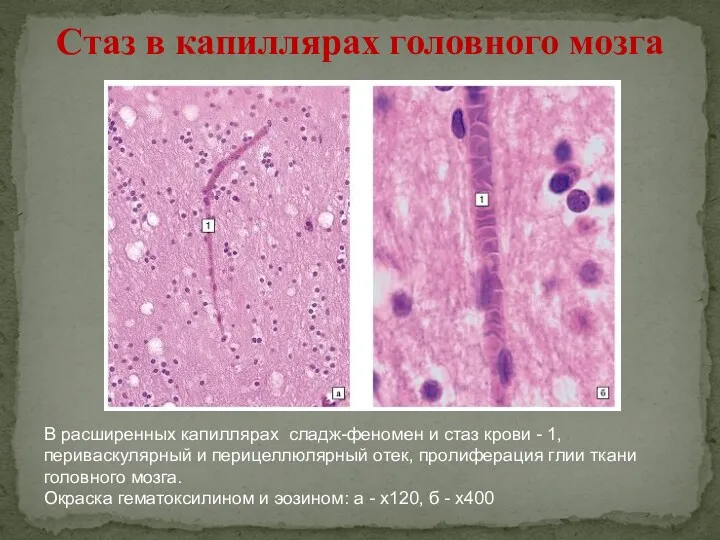 Стаз в капиллярах головного мозга В расширенных капиллярах сладж-феномен и стаз крови -