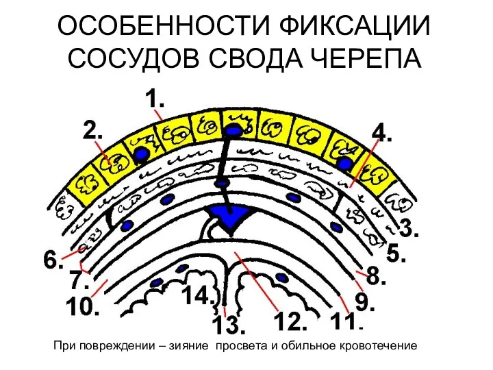 ОСОБЕННОСТИ ФИКСАЦИИ СОСУДОВ СВОДА ЧЕРЕПА При повреждении – зияние просвета и обильное кровотечение