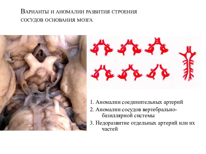 Варианты и аномалии развития строения сосудов основания мозга 1. Аномалии