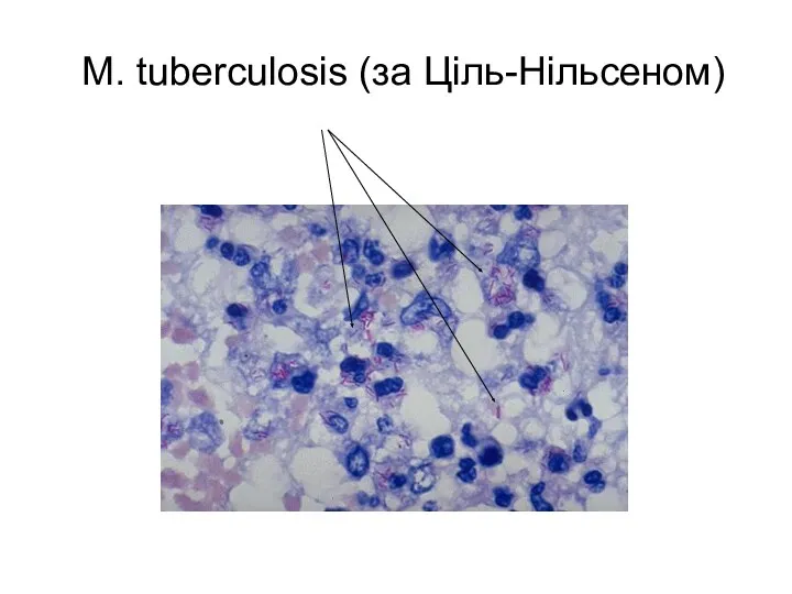 M. tuberculosis (за Ціль-Нільсеном)