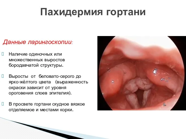 Пахидермия гортани Данные ларингоскопии: Наличие одиночных или множественных выростов бородавчатой