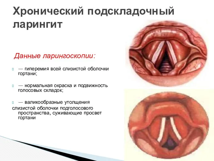 Данные ларингоскопии: — гиперемия всей слизистой оболочки гортани; — нормальная окраска и подвижность