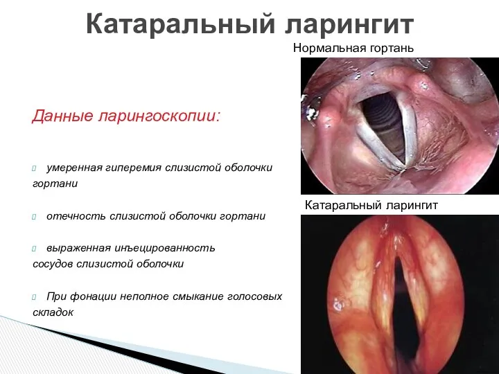 Данные ларингоскопии: умеренная гиперемия слизистой оболочки гортани отечность слизистой оболочки гортани выраженная инъецированность