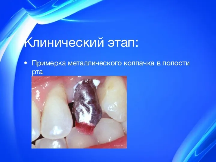 Клинический этап: Примерка металлического колпачка в полости рта