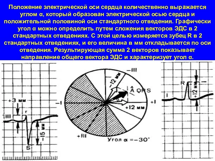 Положение электрической оси сердца количественно выражается углом α, который образован электрической осью сердца