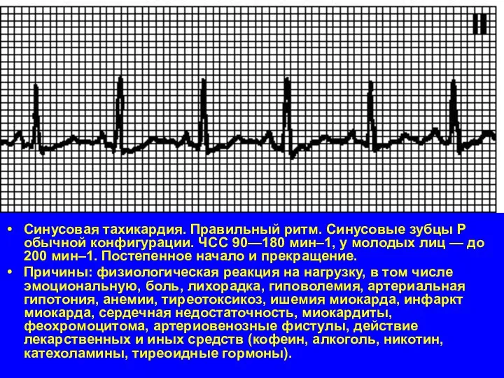 Синусовая тахикардия. Правильный ритм. Синусовые зубцы P обычной конфигурации. ЧСС 90—180 мин–1, у