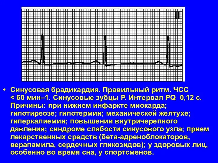 Синусовая брадикардия. Правильный ритм. ЧСС