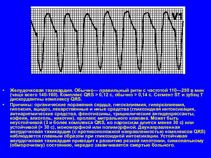 Желудочковая тахикардия. Обычно— правильный ритм с частотой 110—250 в мин (чаще всего 140-160).