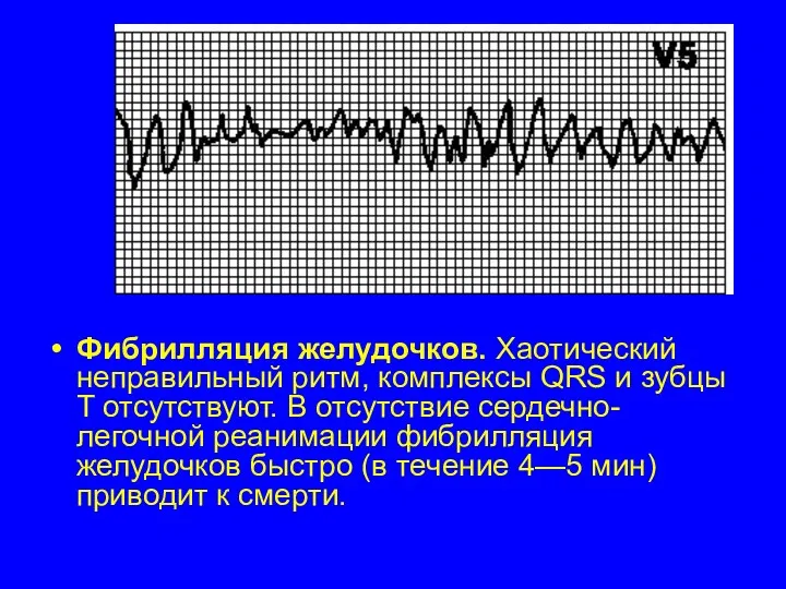 Фибрилляция желудочков. Хаотический неправильный ритм, комплексы QRS и зубцы T отсутствуют. В отсутствие