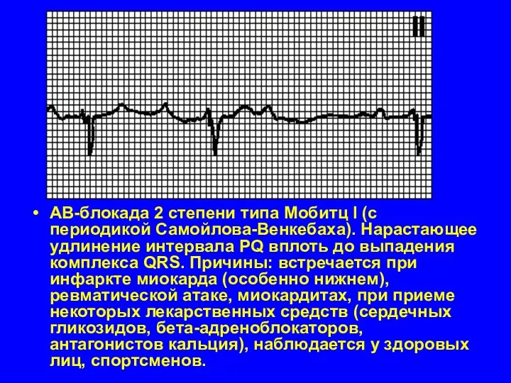 АВ-блокада 2 степени типа Мобитц I (с периодикой Самойлова-Венкебаха). Нарастающее удлинение интервала PQ