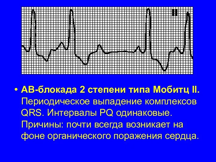 АВ-блокада 2 степени типа Мобитц II. Периодическое выпадение комплексов QRS. Интервалы PQ одинаковые.