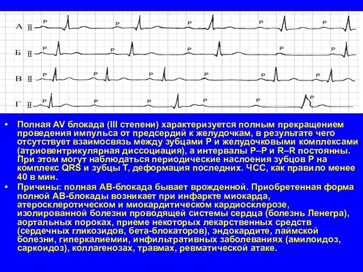 Полная AV блокада (III степени) характеризуется полным прекращением проведения импульса от предсердий к