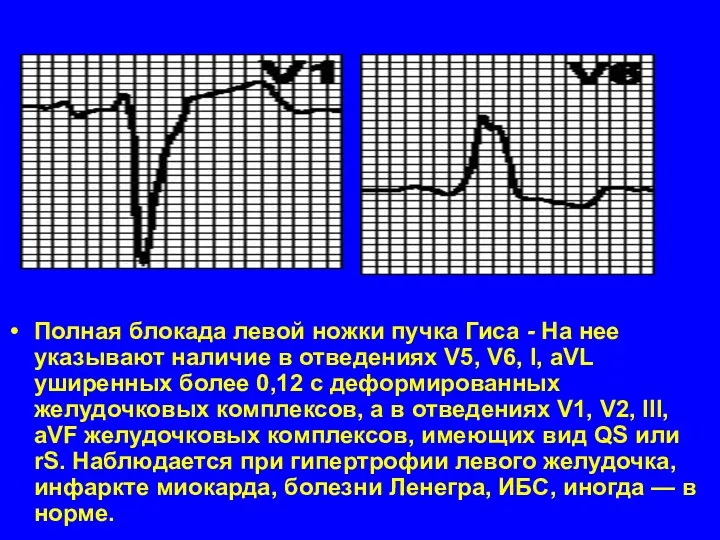 Полная блокада левой ножки пучка Гиса - На нее указывают наличие в отведениях