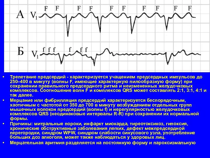 Трепетание предсердий - характеризуется учащением предсердных импульсов до 250–400 в минуту (волны F,