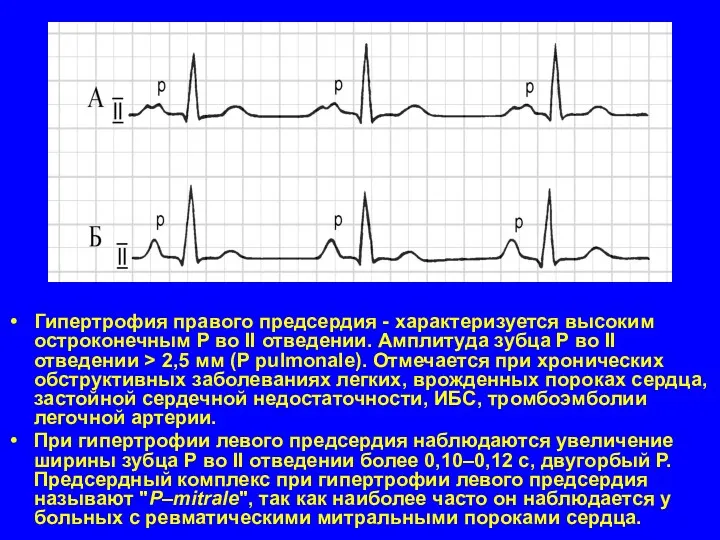 Гипертрофия правого предсердия - характеризуется высоким остроконечным P во II отведении. Амплитуда зубца