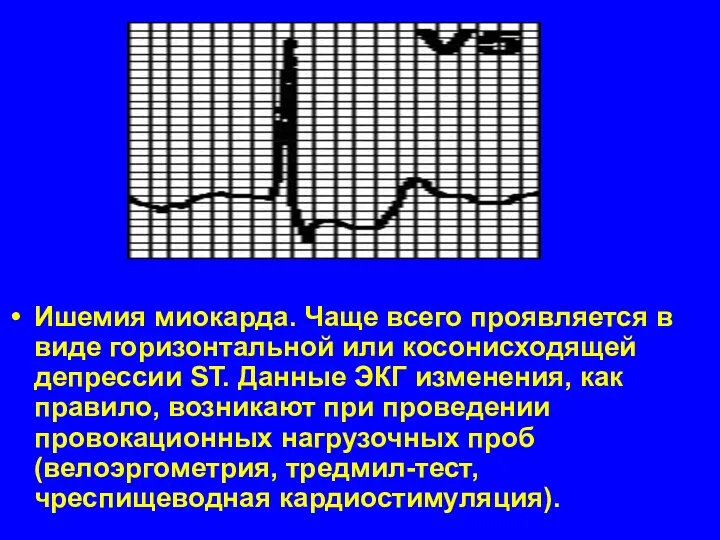 Ишемия миокарда. Чаще всего проявляется в виде горизонтальной или косонисходящей депрессии ST. Данные