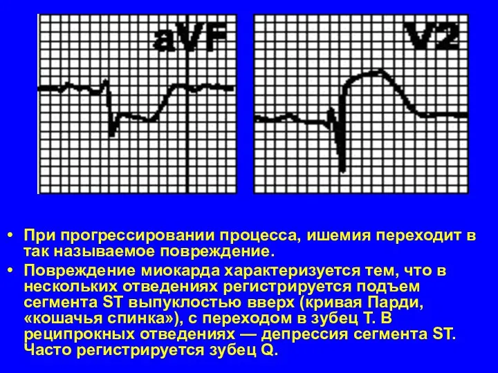 При прогрессировании процесса, ишемия переходит в так называемое повреждение. Повреждение миокарда характеризуется тем,