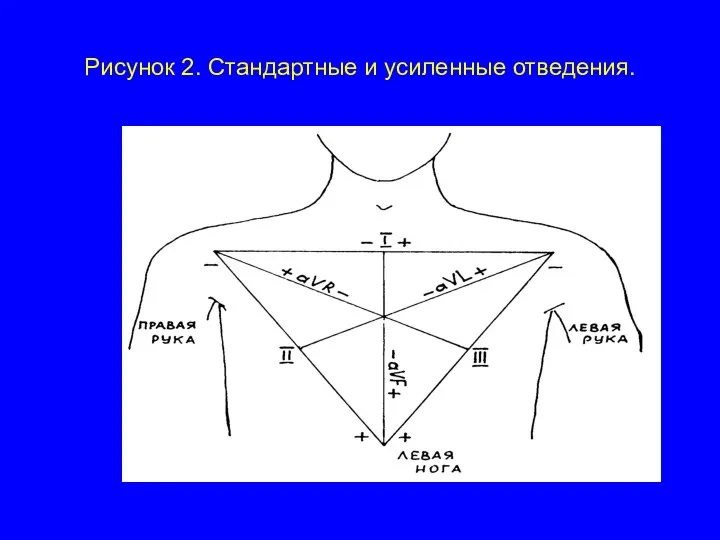 Рисунок 2. Стандартные и усиленные отведения.