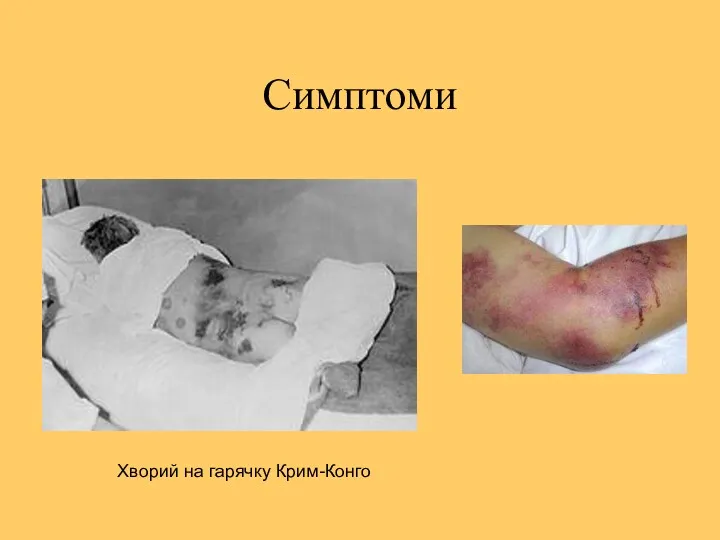 Симптоми Хворий на гарячку Крим-Конго
