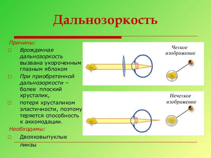 Дальнозоркость Причины: Врожденная дальнозоркость вызвана укороченным глазным яблоком При приобретенной