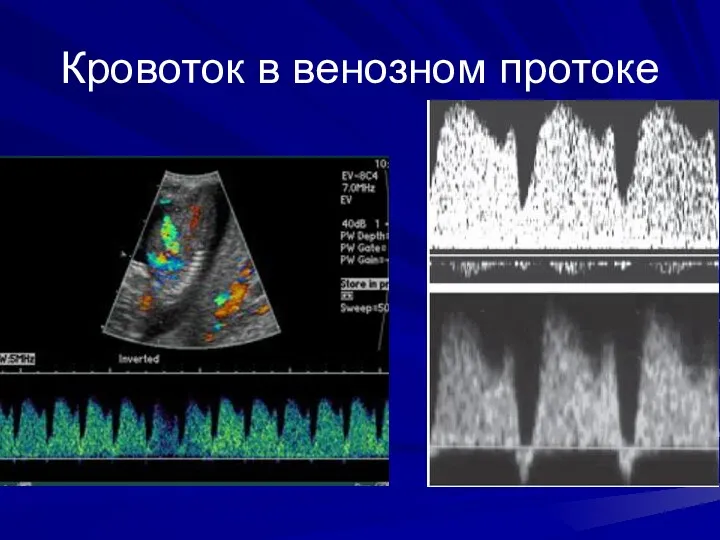 Кровоток в венозном протоке