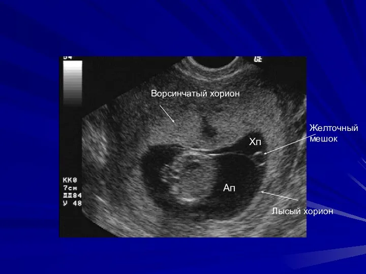 Желточный мешок Ап Хп Ворсинчатый хорион Лысый хорион