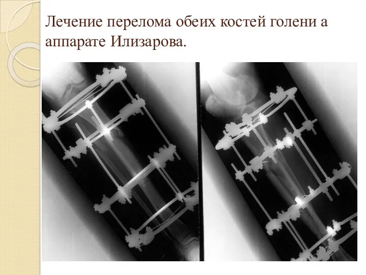 Лечение перелома обеих костей голени а аппарате Илизарова.