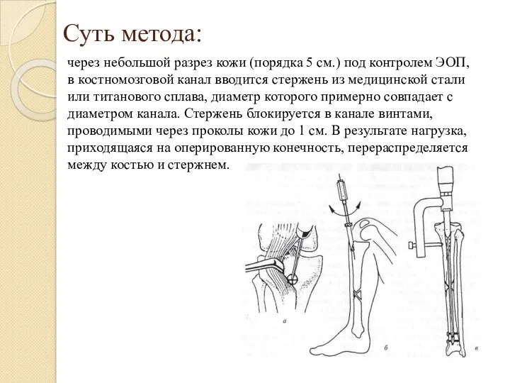 Суть метода: через небольшой разрез кожи (порядка 5 см.) под