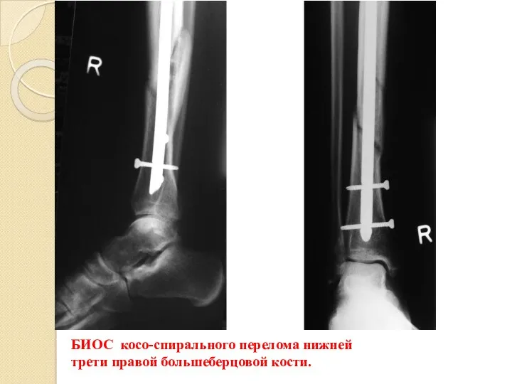 БИОС косо-спирального перелома нижней трети правой большеберцовой кости.