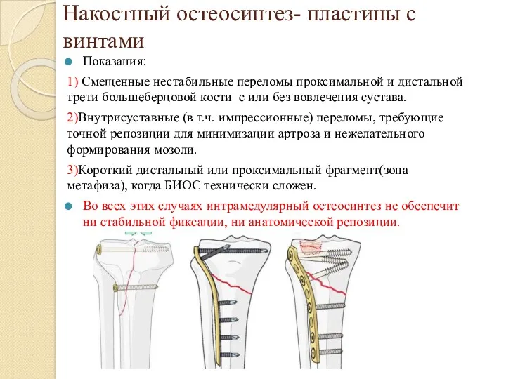Накостный остеосинтез- пластины с винтами Показания: 1) Смещенные нестабильные переломы