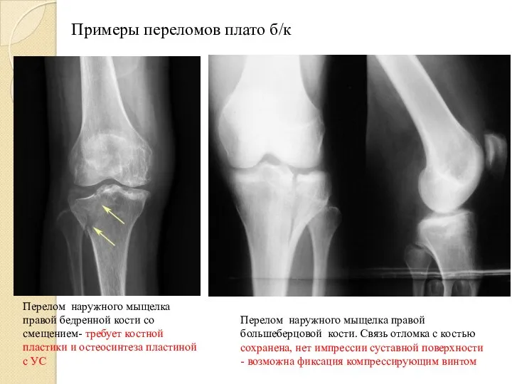 Перелом наружного мыщелка правой бедренной кости со смещением- требует костной