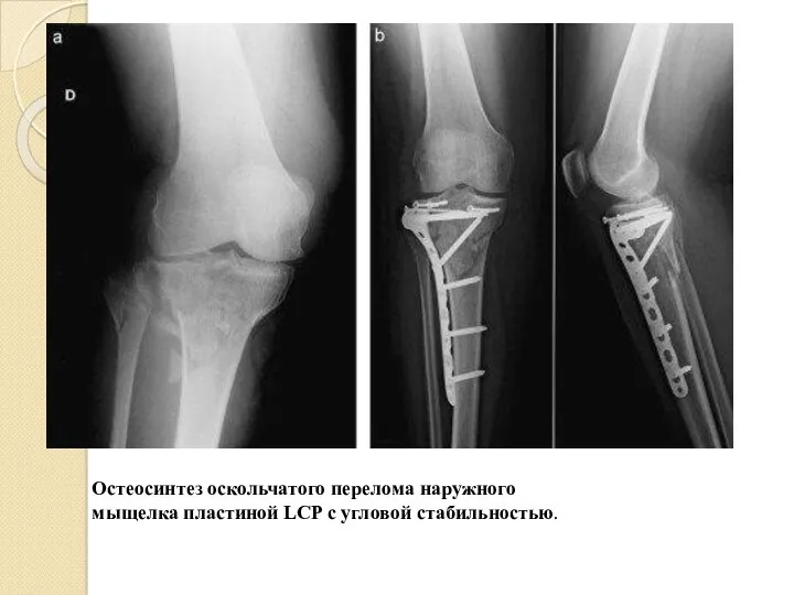 Остеосинтез оскольчатого перелома наружного мыщелка пластиной LCP с угловой стабильностью.