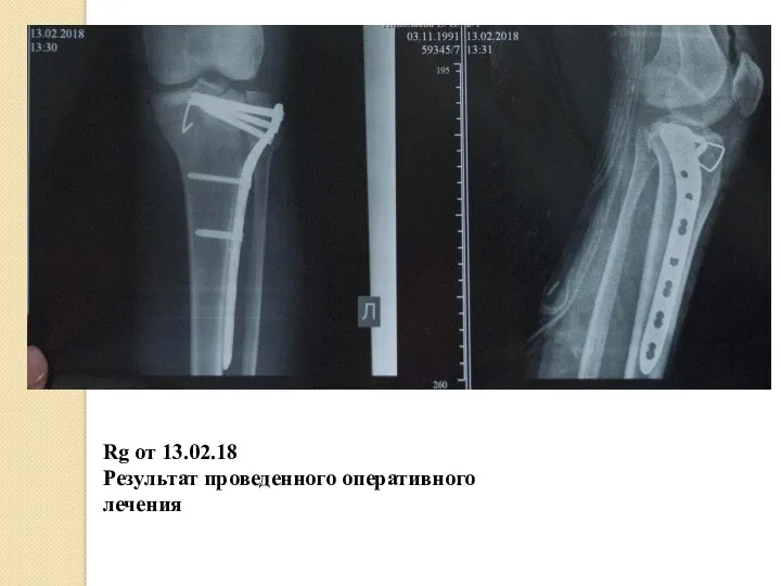 Rg от 13.02.18 Результат проведенного оперативного лечения