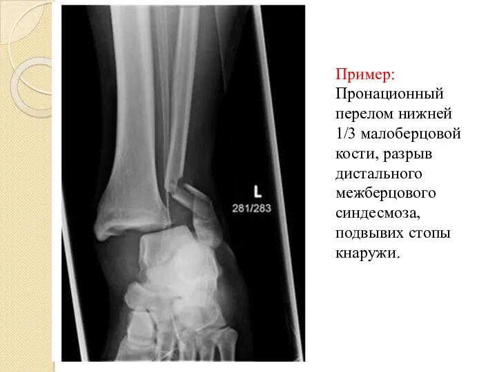 Пример: Пронационный перелом нижней 1/3 малоберцовой кости, разрыв дистального межберцового синдесмоза, подвывих стопы кнаружи.