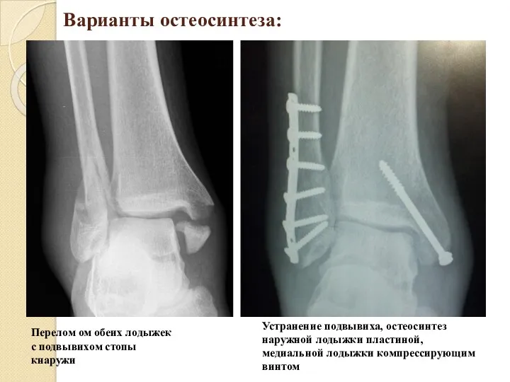 Варианты остеосинтеза: Перелом ом обеих лодыжек с подвывихом стопы кнаружи