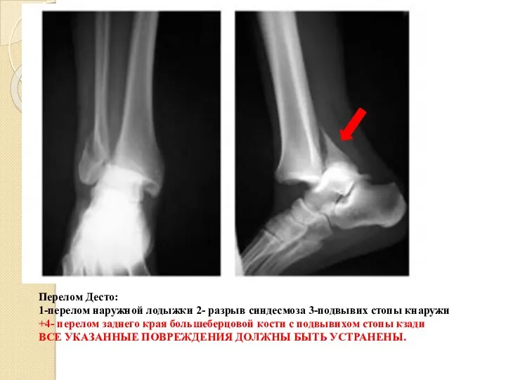 Перелом Десто: 1-перелом наружной лодыжки 2- разрыв синдесмоза 3-подвывих стопы