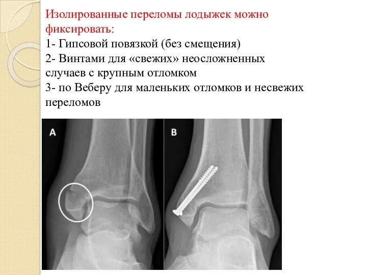 Изолированные переломы лодыжек можно фиксировать: 1- Гипсовой повязкой (без смещения)