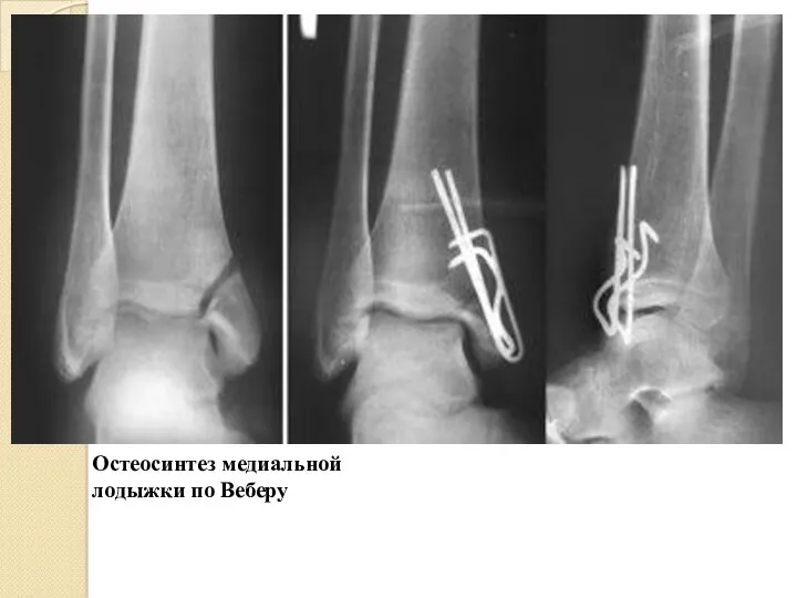 Остеосинтез медиальной лодыжки по Веберу