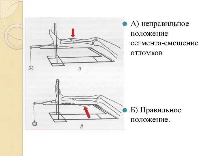 А) неправильное положение сегмента-смещение отломков Б) Правильное положение.