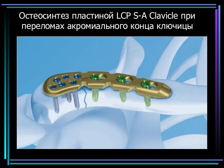 Остеосинтез пластиной LCP S-A Clavicle при переломах акромиального конца ключицы