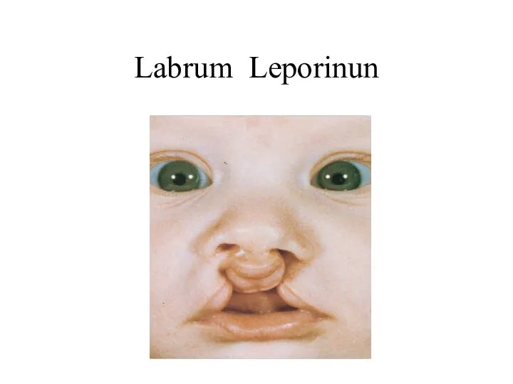 Labrum Leporinun