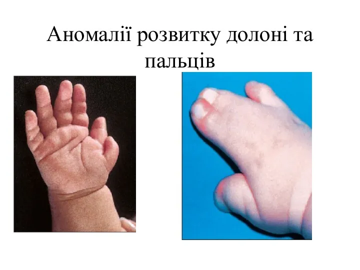 Аномалії розвитку долоні та пальців