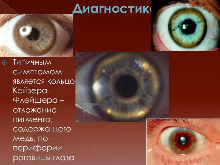 Диагностика Типичным симптомом является кольцо Кайзера-Флейшера – отложение пигмента, содержащего медь, по периферии роговицы глаза