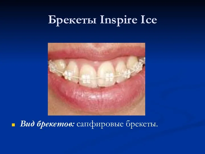 Брекеты Inspire Ice Вид брекетов: сапфировые брекеты.